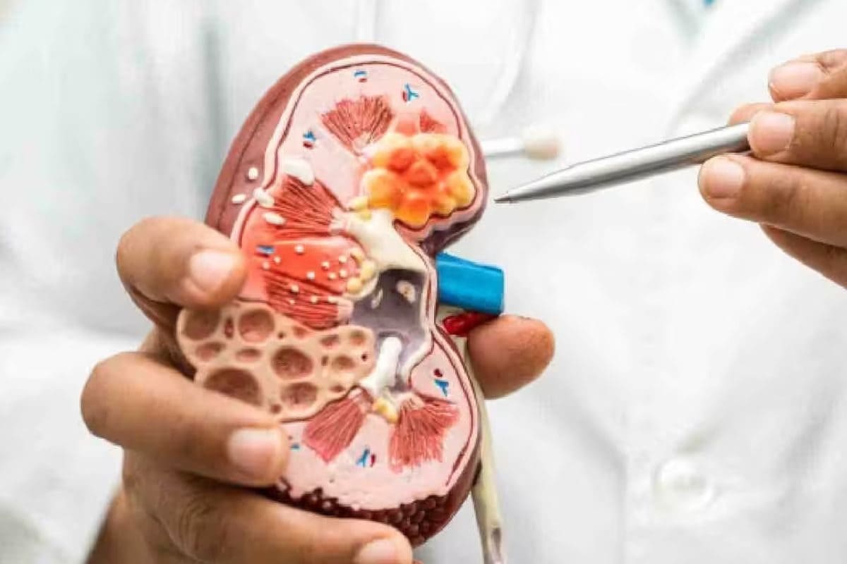 Why Kidney Stone Cases are Rising Among Gen Z and Millennials; Doctors Share Dos and Don’ts