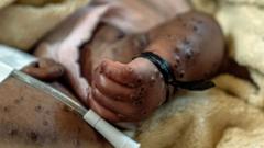 Nurses working in fear: BBC visits mpox frontline