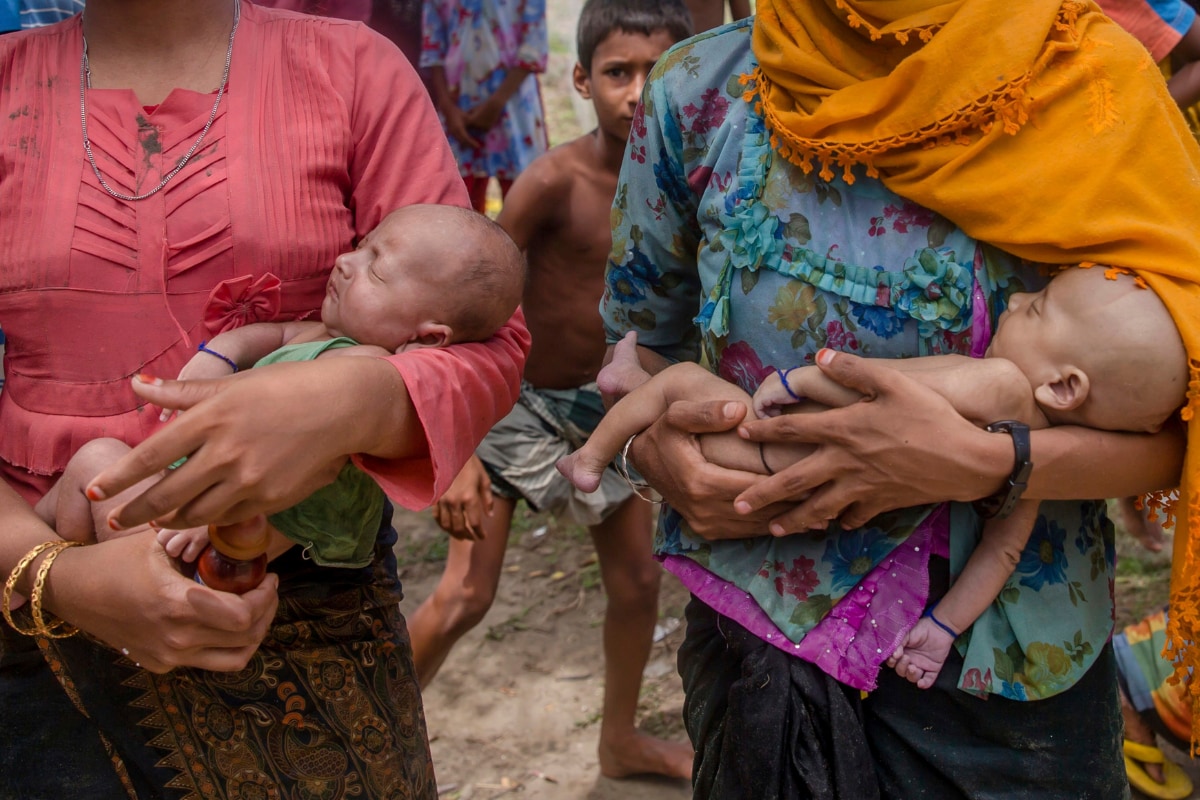 Twins Born In Rajasthan With Rare Condition, Have Plastic-Like Skin