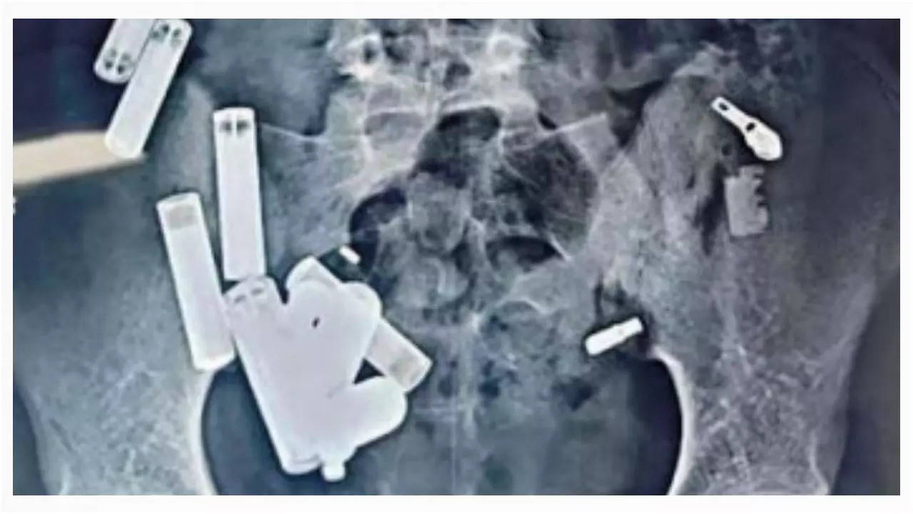 Batteries, chains, screws: 65 objects in stomach kill 14-year-old Hathras boy Batteries, chains, screws: 65 objects in stomach kill 14-year-old Hathras boy