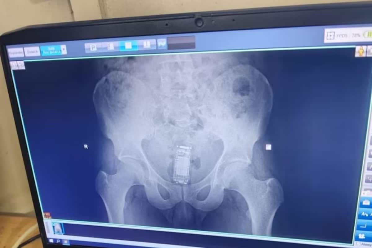 X-Ray Reveals POCSO Accused Hiding Mobile Phone In His Rectum In Gujarat’s Bhavnagar Jail