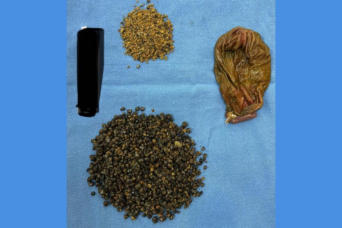 In Rare Surgery, Doctors Unburden 70-Year-Old Gurugram Man Of 8,000 Gallstones