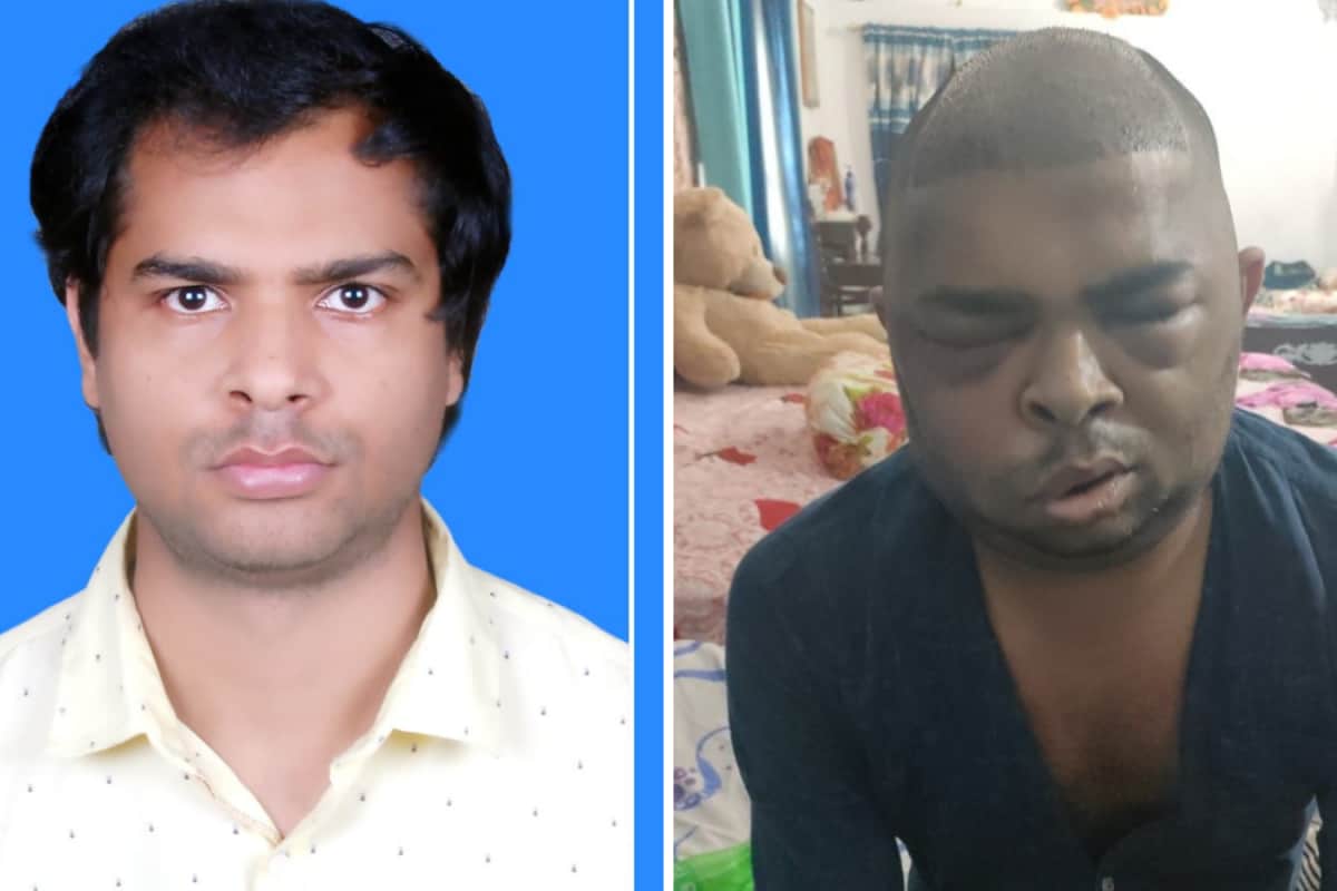 Is A New Hairline Worth Your Lifeline? Inside Kanpur’s Growing Epidemic Of Botched Transplants