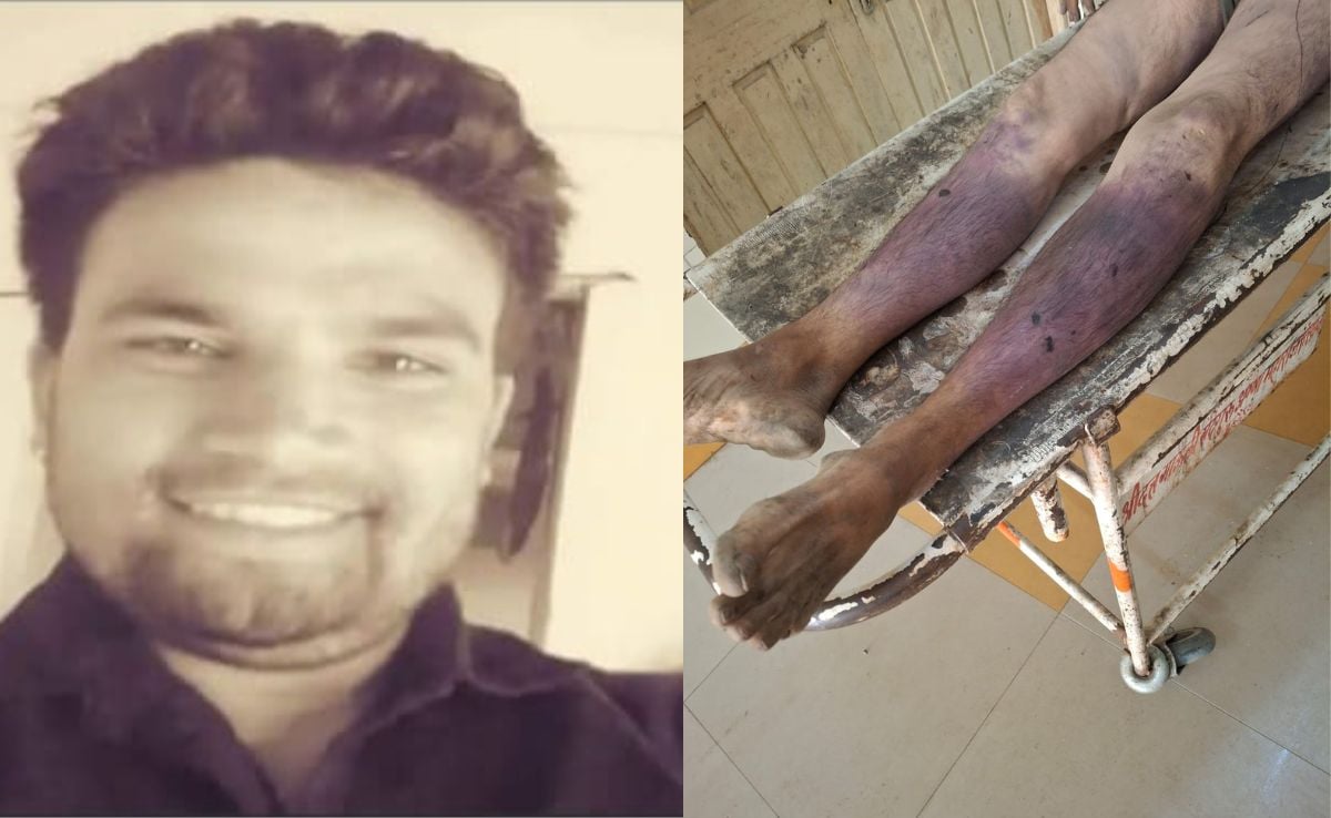 40 Fractures, Blunt Trauma: Indore Man Assaulted Over Theft Suspicion