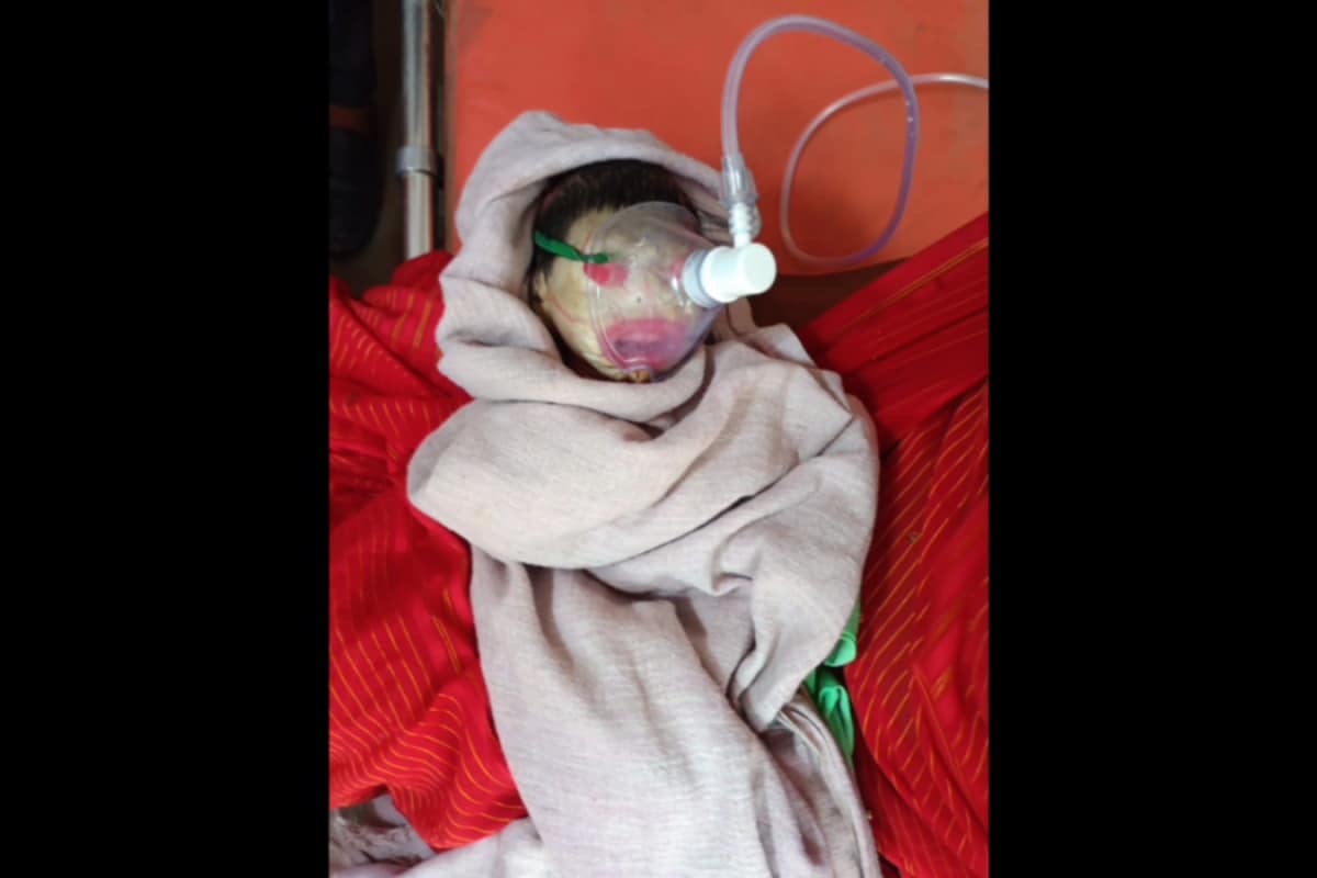 Collodion Baby: Newborn With Rare Skin Condition Admitted To ICU In MP’s Rewa