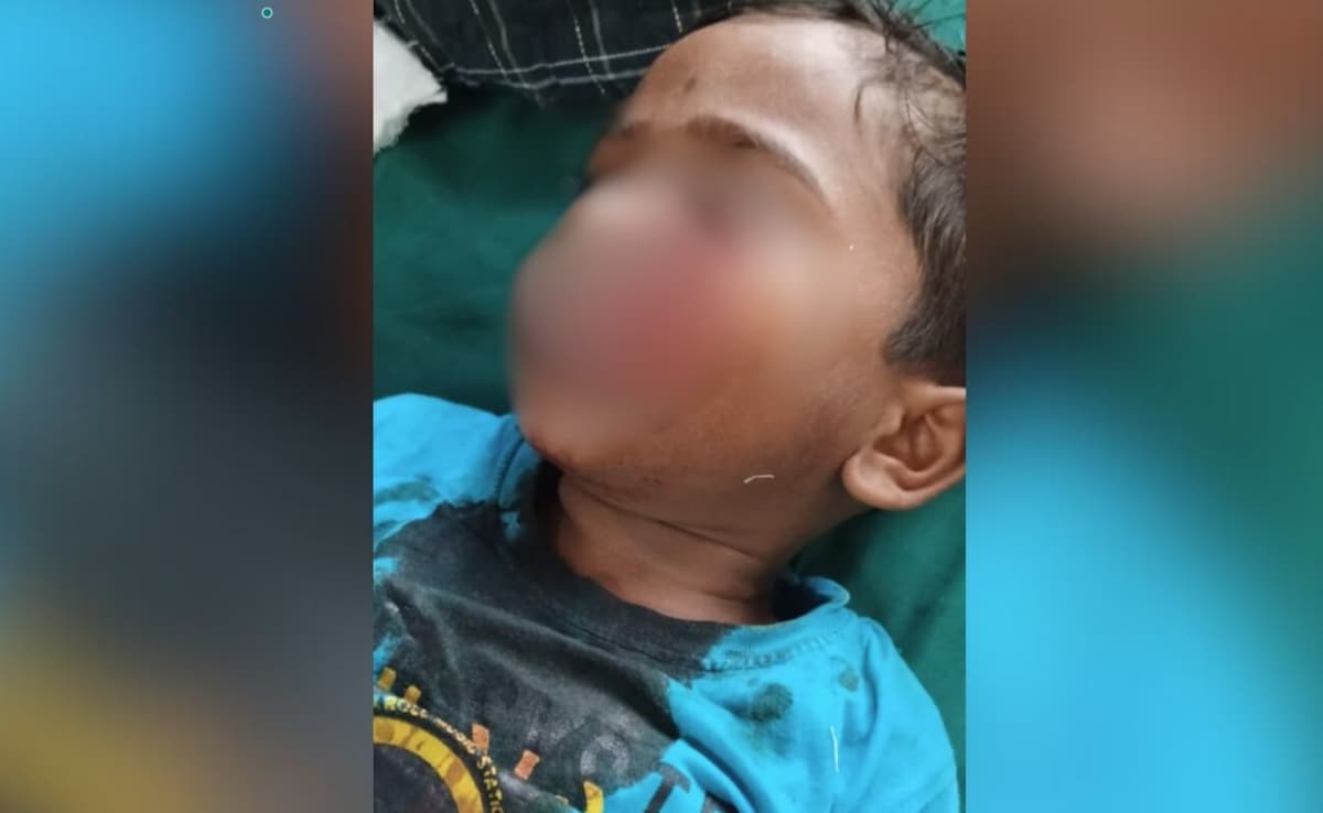 4-Year-Old Boy’s Face Bitten Off By Stray Dogs In Maharashtra